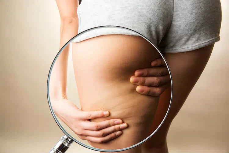 3 mitos sobre la celulitis – ¡desenmascarados!