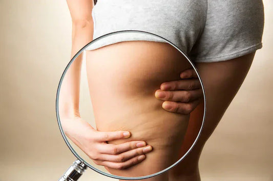3 mitos sobre la celulitis – ¡desenmascarados!